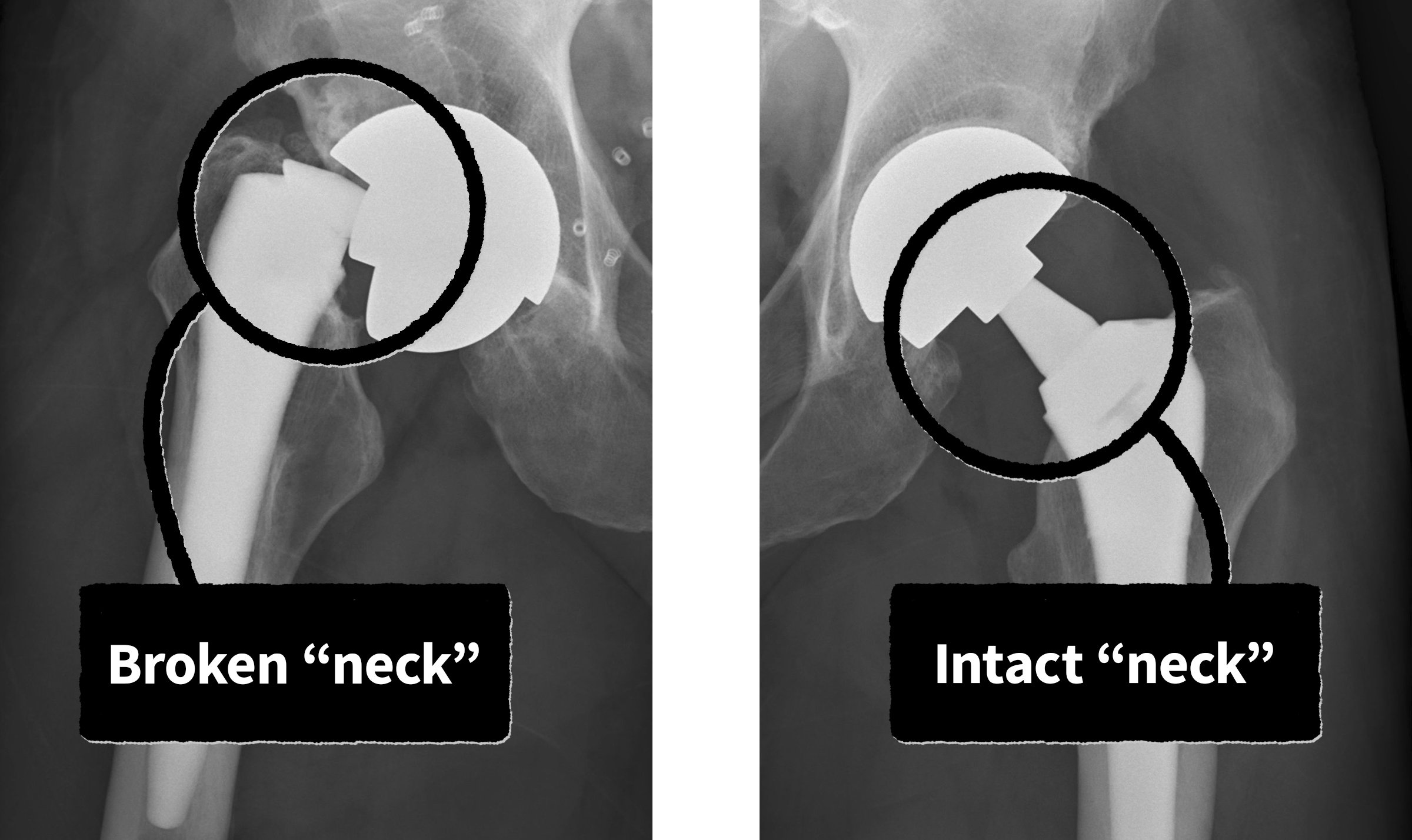 Two sides of an x-ray are shown. The left side is of the right hip; the Profemur implant's neck is broken. On the right side of the image, the left hip, the implant is intact.